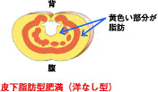 皮下脂肪型肥満(洋なし型)
